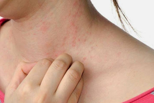 Phát ban đỏ trên da là một trong những tác dụng phụ có thể gặp khi sử dụng thuốc tetracyclin trị mụn